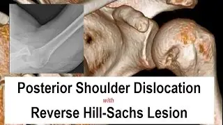 Posterior Shoulder Dislocation Reduction