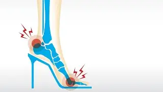 Easy Fixes For High Heel Pain, Arch Pain + Athletes Foot | Dr. Brad From My Feet Are Killing Me