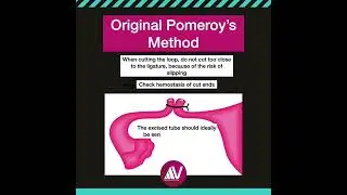 Pomeroy original  Technique