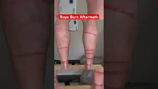 Aftermath of SEVERE Rope Burns… #funny #comedy #science