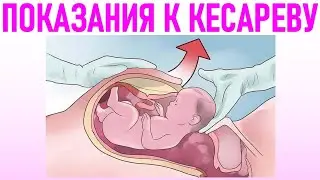 РЕАЛЬНЫЕ ПОКАЗАНИЯ К КЕСАРЕВУ СЕЧЕНИЮ | Когда делают кесарево сечение