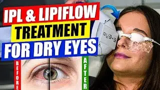 IPL & LipiFlow Treatment For Dry Eyes | आँखों में सूखापन के सबसे अच्छा इलाज By Dr. Tushar Grover