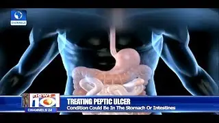 How To Treat Peptic Ulcer |Health Focus|