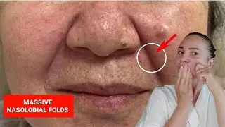 Massage for massive nasolabial folds |  NO WORDS