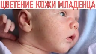 ЦВЕТЕНИЕ КОЖИ У НОВОРОЖДЕННЫХ | Как ухаживать за кожей новорожденного при цветении