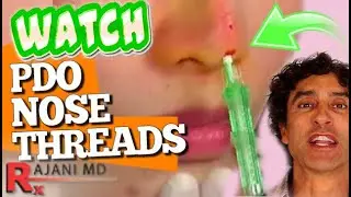 PDO NOSE THREAD LIFT- Non Surgical Nose Job