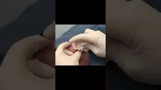 AN OOEY GOOEY CYST