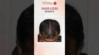 See our #Hairlosstreatment Patients Success Stories. #hairloss #hairlossprevention #hairlosscauses