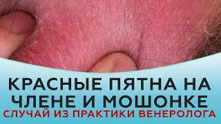 Красные пятна на члене и мошонке. Случай из практики венеролога