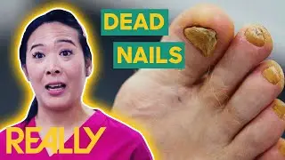 Removing Yellow Nails And Fixing A Deformed Toe | The Bad Foot Clinic