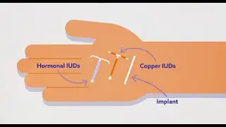 IUDs for Contraception