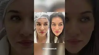 Увеличение скул филлерами: показания к процедуре