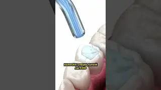 Как лечится кариес?? 