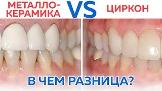 Какие коронки делать? / Плюсы и минусы металлокерамики и диоксида циркония