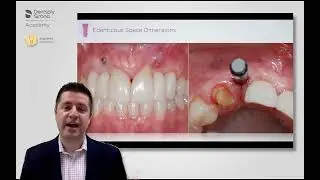 Putting Both Horizontal & Vertical Space Considerations Into Implant Planning