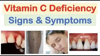 Vitamin C Deficiency Signs & Symptoms, Consequences (& Why They Occur)