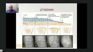 Боль в коленном суставе Карелов А.Е.