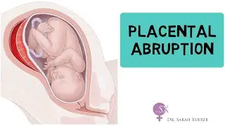 Placental Abruption