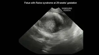 Videoclip from #uogjournal presents ultrasound features of Raine syndrome in fetuses