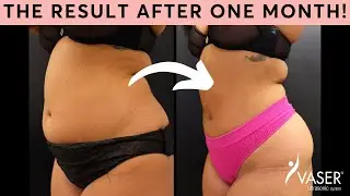 The Only Liposuction Method That’s Safe AND Effective!