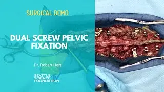 Dual Screw Pelvic Fixation - Robert A. Hart, MD