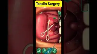 Tonsils Surgery 3D Animation 