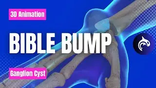 Learn about Bible Bumps (Ganglion Cysts) in 3D