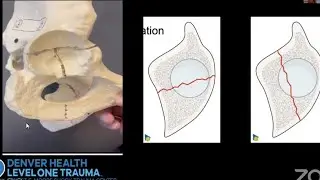 Associated Acetabular Fractures