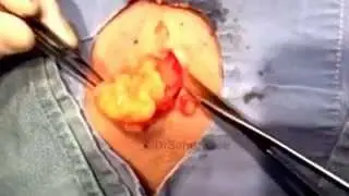 Dr Jeff Rebish excising a lipoma on the back. (No sound)For medical education- NSFE.
