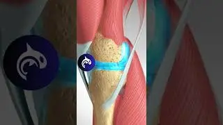 See what a Baker's Cyst of the Knee looks like in 4K 3D Animation
