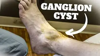 HUGE Ankle Ganglion Cyst Aspiration Surgery - *Foot & Ankle Treatment*