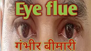 Eye Flue | एक गम्भीर बीमारी | आंखों में जलन | @eyedoctor_MY_KIM #eyes #medical आई फ्लू |