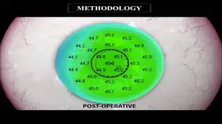AIOC2018 - FP600 - Refractive Surgery - Photorefractive Intrastromal