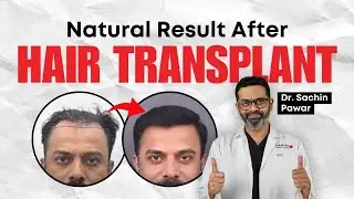 Natural Result after Hair Transplant | Dr. Sachin Pawar | HairMD Pune