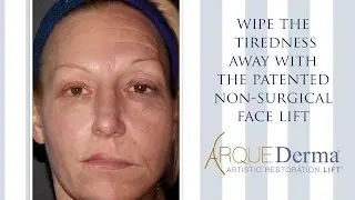 Watch how the morphing of this patient's face reveals a more rested, refreshed version of herself.