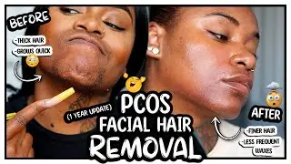 PCOS FACIAL HAIR REMOVAL: 1 Year Hirsutism Update & HOME Wax Routine!