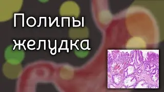 Полипы желудка | Патология