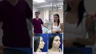 Как ринопластика меняет жизнь. Новый носик за пару часов, вполне реально. Обращайтесь 🤗