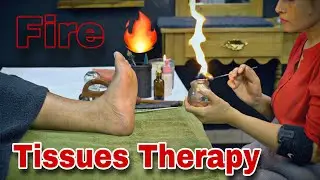 Chinese Fire 🔥 Sleep Massage💈Foot Reflexology💈Iron Needle ASMR ACUPRESSURE TECHNIQUE