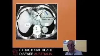 Pacemaker lead extraction - Dr Peter Brady