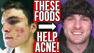 BEST FOODS TO GET RID OF ACNE (FROM EXPERIENCE)