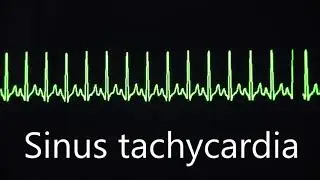 Sinus rhythm, bradycardia and tachycardia