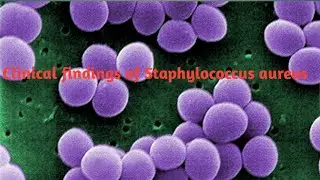 Clinical findings of staphylococcus aureus