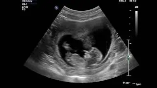 Advanced Early Pregnancy Scan (12-19 weeks)