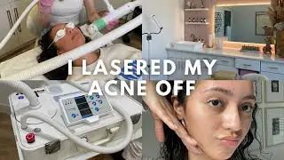 I Lasered My Acne Off?! Trying Aerolase for the First Time! | Sloan Byrd