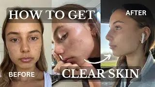 HOW TO GET CLEAR SKIN: the skincare routine that got rid of my acne!