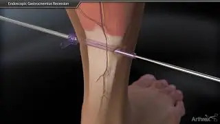 Endoscopic Gastrocnemius Recession