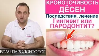 Кровоточивость десен - причины, последствия, лечение! Гингивит и пародонтит - что делать?