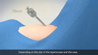 Abdominal entry In laparoscopic gynecologic surgery