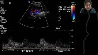 Fibromuscular Dysplasia